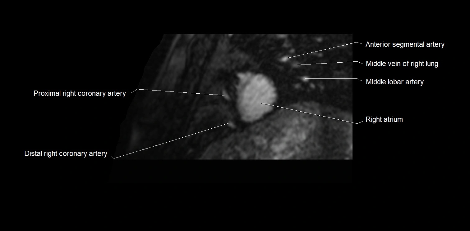 MRI heart and coronary arteries two chamber(sagittal)  anatomy image 3.webp